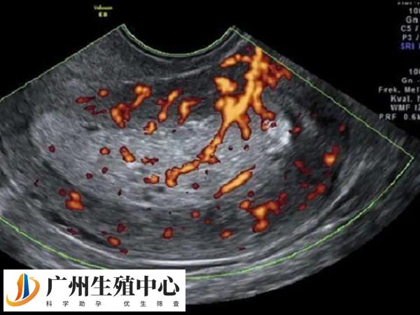 B超检查可以评估子宫内膜厚度和血液供应