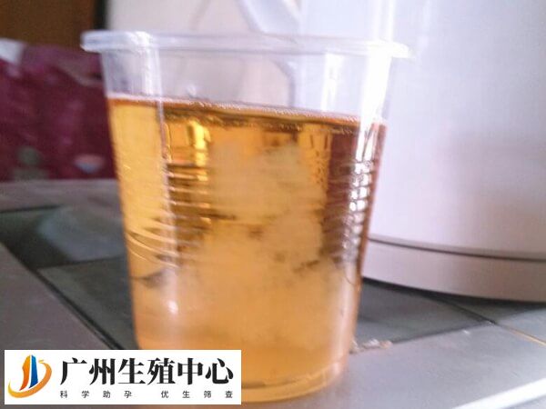 晨尿加酒精后出现一团一团的物体表明生男孩